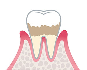 軽度歯周炎のイラスト