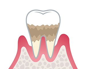 中等度歯周炎のイラスト