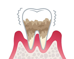 重度歯周炎のイラスト
