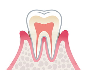 軽度の歯周病のイラスト