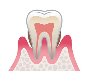 中度の歯周病のイラスト