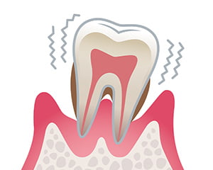 重度の歯周病のイラスト